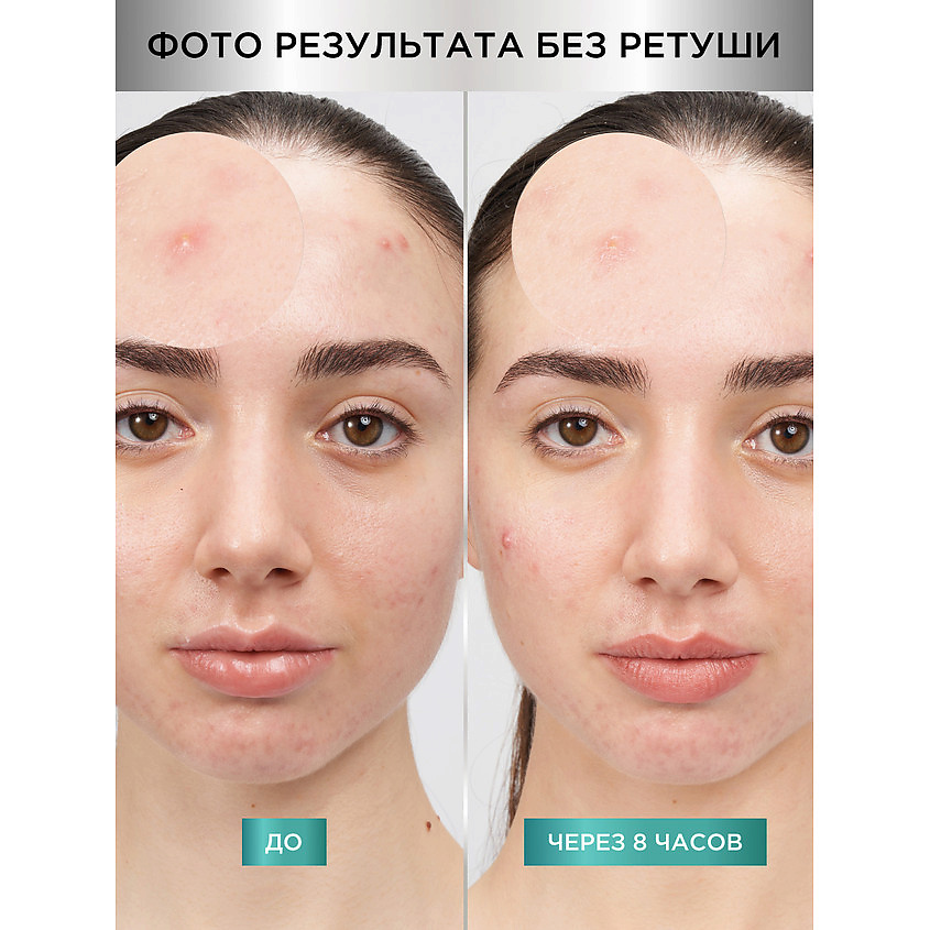 GARNIER Гидроколлоидные невидимые патчи от прыщей Pimple Patches PureActive – фото 6